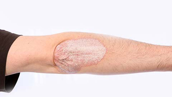 If I Have Psoriasis Will I Also Have Psoriatic Arthritis?