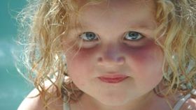 How should my child’s sunburn be treated?