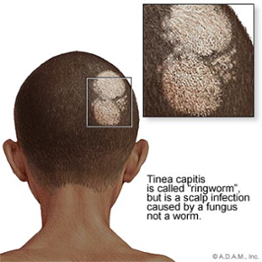 Picture of tinea capitis