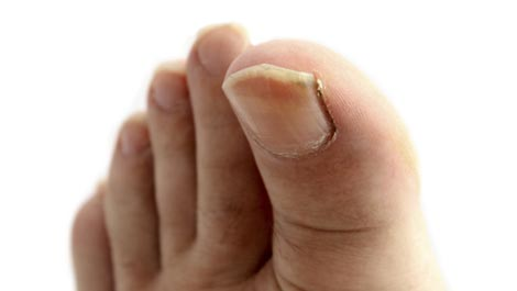 Why can't you clip a diabetic's toenails or fingernails?