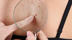 Skin Cancer Treatment