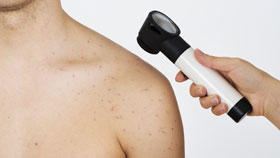 Stage 1 Basal Cell Carcinoma Stage 1 Basal Cell Carcinoma