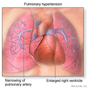 Picture of pulmonary hypertension