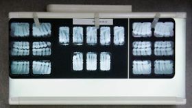 3 Questions to Ask Your Dentist About Dental X-Rays