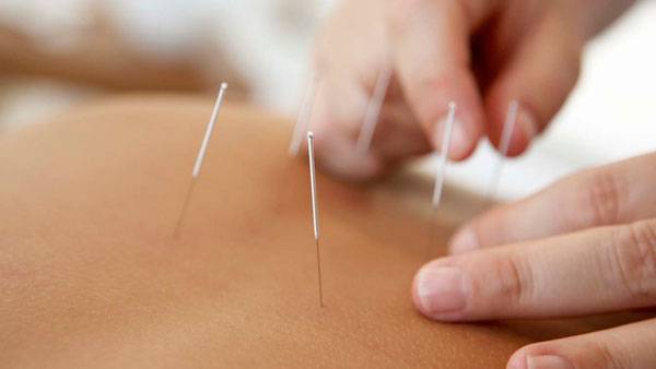 Can Acupuncture Be Used to Treat Depression?