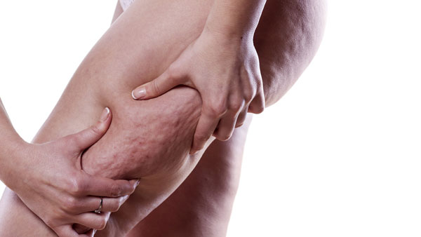 What Causes Cellulite?