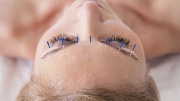 how should i take care of myself after acupuncture ?