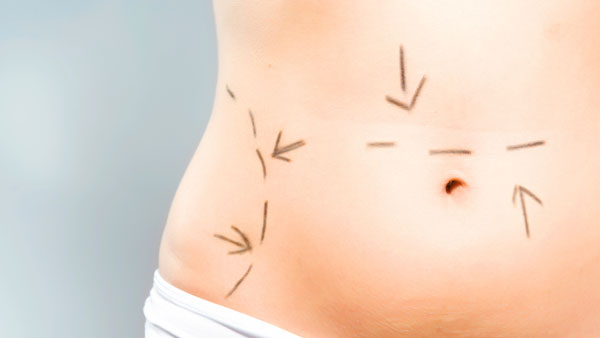 what is an abdominoplasty ?