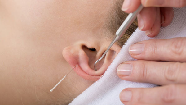 how is ear acupuncture different from traditional acupuncture ?