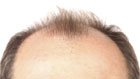 Receding Hairline