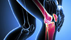 Arthritis Pain